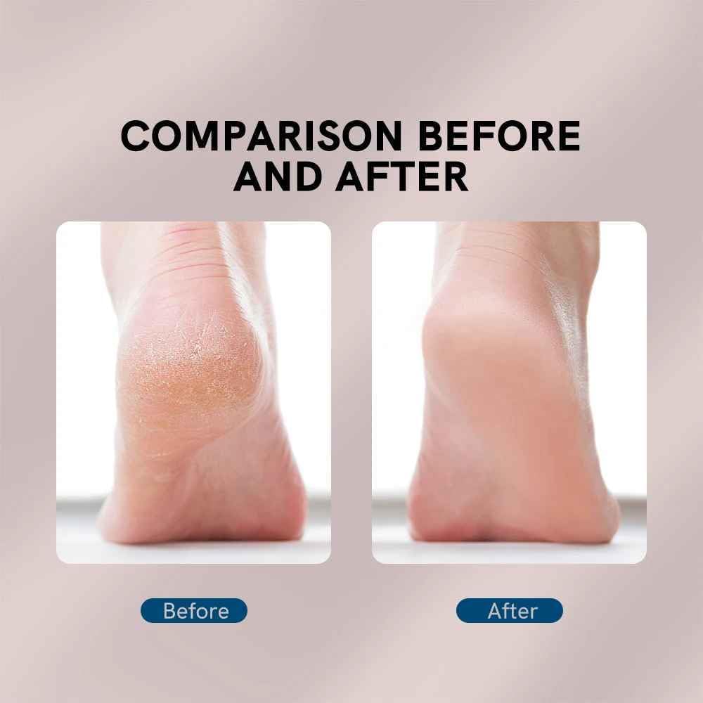Electric Pedicure Foot File Callus Remover – Smooth & Soft Feet Care Tool