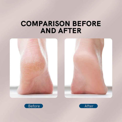 Electric Pedicure Foot File Callus Remover – Smooth & Soft Feet Care Tool
